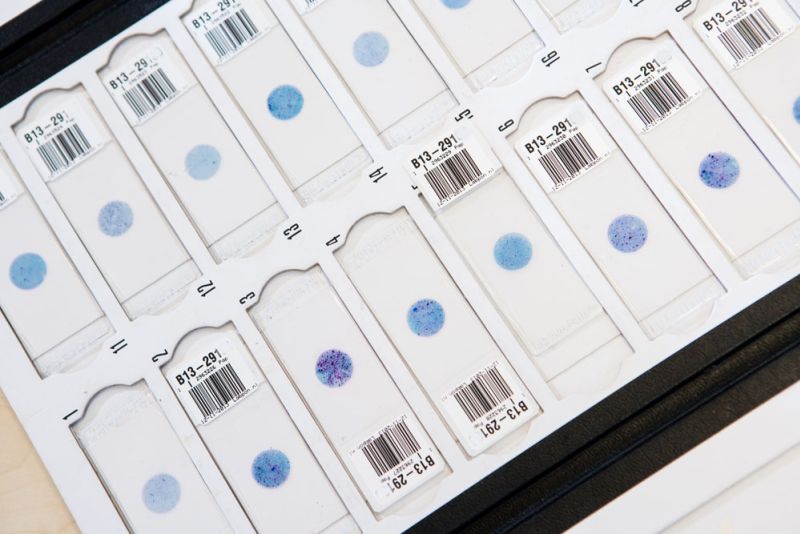 pap-gekleurde-cytologische-preparaten-labpon-5ade18b0 Onderzoek baarmoederhalskanker