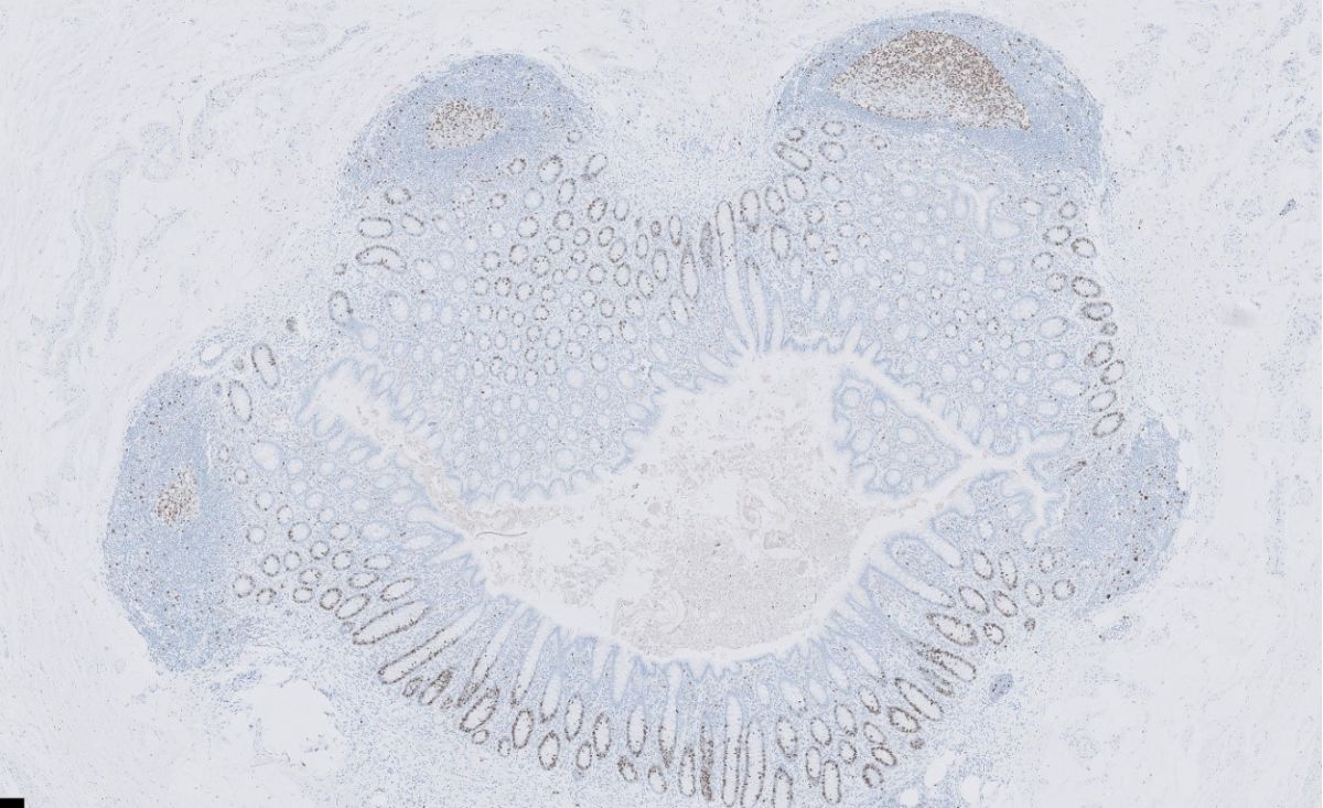 Foto 1 : Ki-67 kern kleuring, delende cellen in blinde darm.