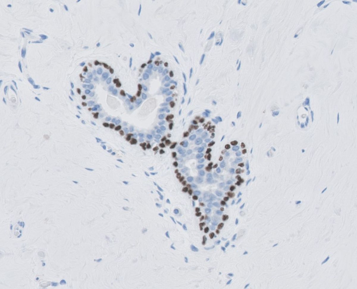 Foto 2 : P63 kernkleuring, myo-epitheliale cellen in klierbuizen van mamma(borst)weefsel.